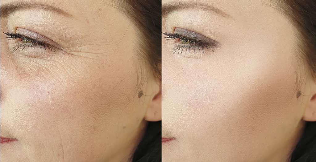 Wrinkle Therapy 1024x526