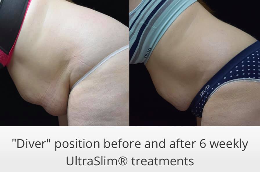 Ultraslim 2 Best Fat Reduction Loss Treatment Los Angeles Coolsculpting Lipo Alternative