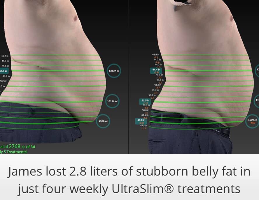 Ultraslim 5 Best Fat Reduction Loss Treatment Los Angeles Coolsculpting Lipo Alternative Proven Red Light Therapy