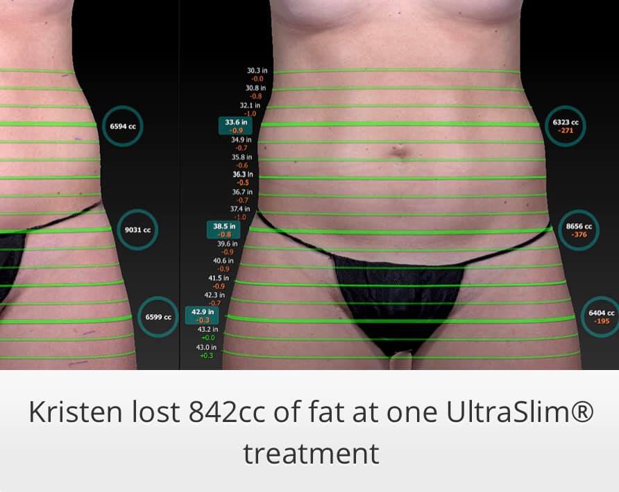 Ultraslim 6 Best Fat Reduction Loss Treatment Los Angeles Coolsculpting Lipo Alternative Proven Red Light Therapy