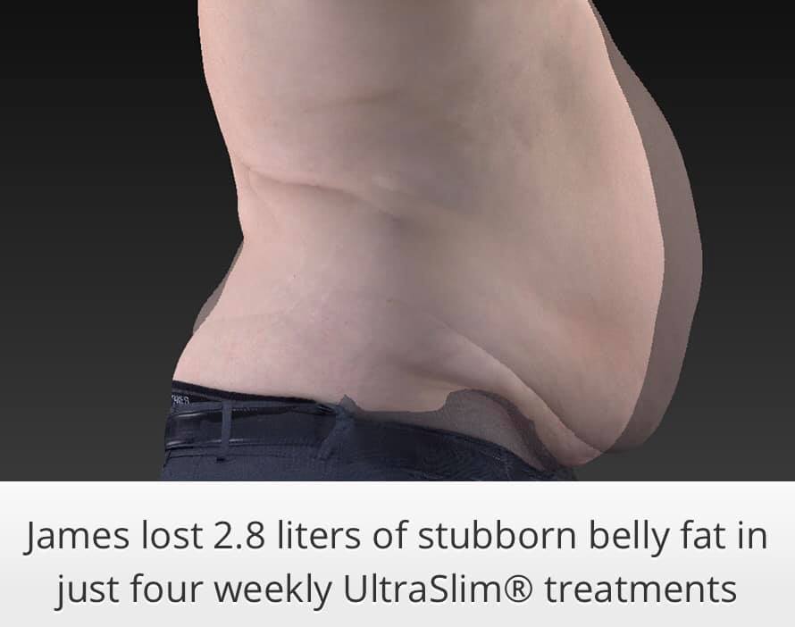 Ultraslim 9 Best Fat Reduction Loss Treatment Los Angeles Coolsculpting Lipo Alternative Proven Red Light Therapy