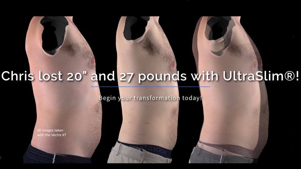 Ultraslim Best Fat Reduction Loss Treatment Los Angeles Coolsculpting Lipo Alternative