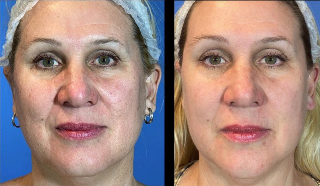 Sofwave Skin Tightening Treatment Alternative Ultherapy Sculptra Los Angeles Pasadena Wrinkles Fine Lines