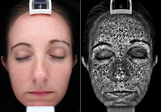 Visia Skin Analysis Uv Spots Big
