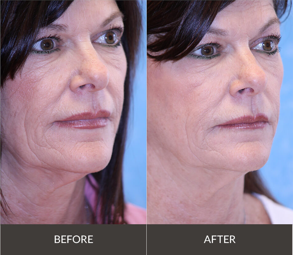 Sofwave 1b Before After Photo Face Skin Tightening Treatment Los Angeles Pasadena CA